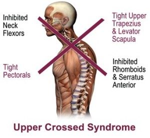 Upper Crossed Syndrome involves inhibited neck flexor muscles, inhibited rhomboids, serratus anterior and lower trapezius muscles, tight pec muscles and tight upper trapezius and levator scapula muscles.